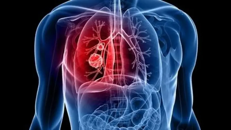 دراسة تكشف “القاتل الخفي” الذي يسبب سرطانات الرئة لغير المدخنين